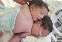 Newborn conjoined twins die in Sana’a as result of medical shortage due to war