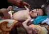 UNRWA: 508 Children Diagnosed With Acute Malnutrition in Gaza Two Years After Genocide