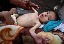 UNRWA: 508 Children Diagnosed With Acute Malnutrition in Gaza Two Years After Genocide